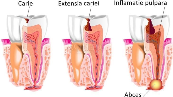 caria dentara